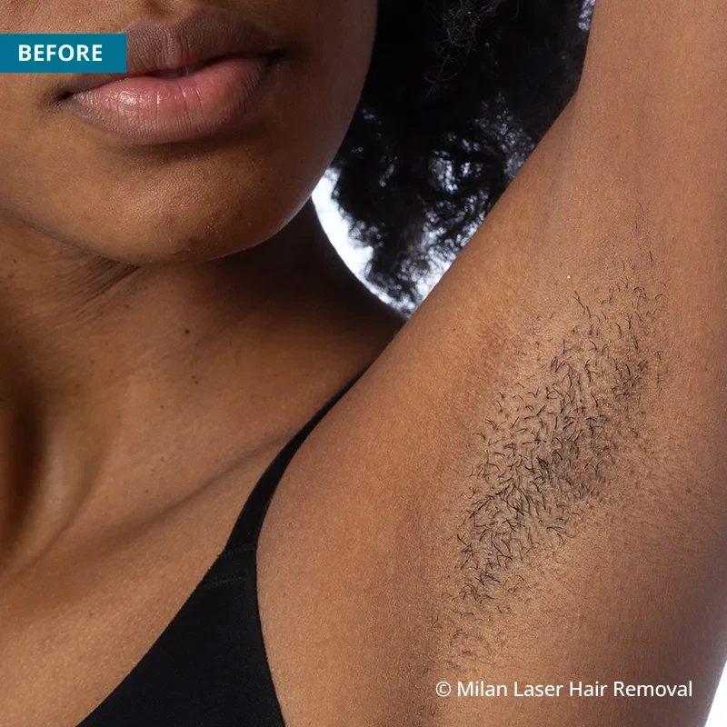 Laser Hair Removal - Remove Underarms Hair Permanently | Gurgaon, Delhi,  India - YouTube