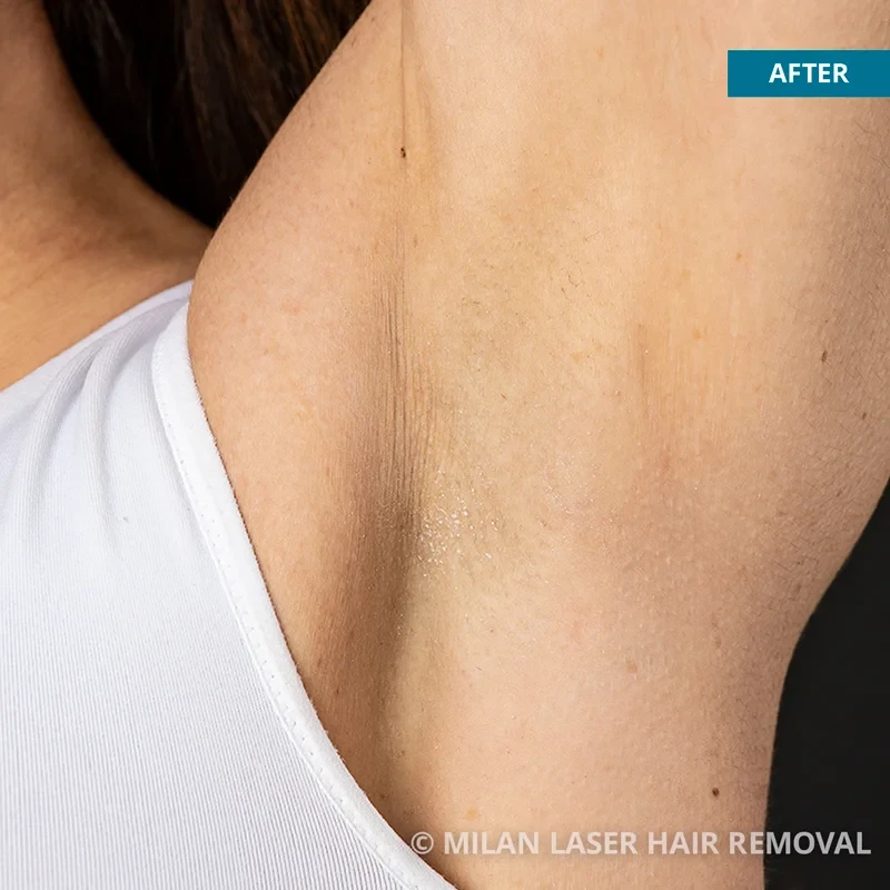 Cost of Laser Hair Removal San Diego | The Laser Cafe