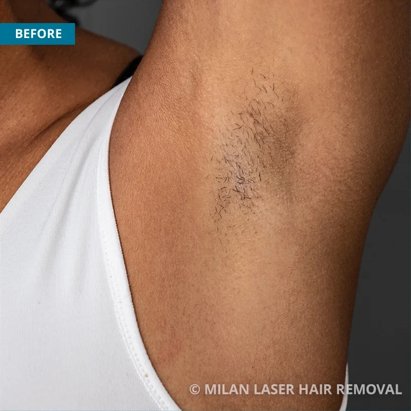 Laser Hair Removal Armpit / Underarm « DERMAWORLD SKIN CLINIC