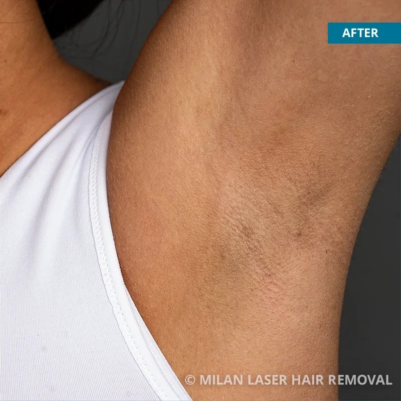 Laser Hair Removal Minneapolis-St. Paul | Heather Rocheford, MD